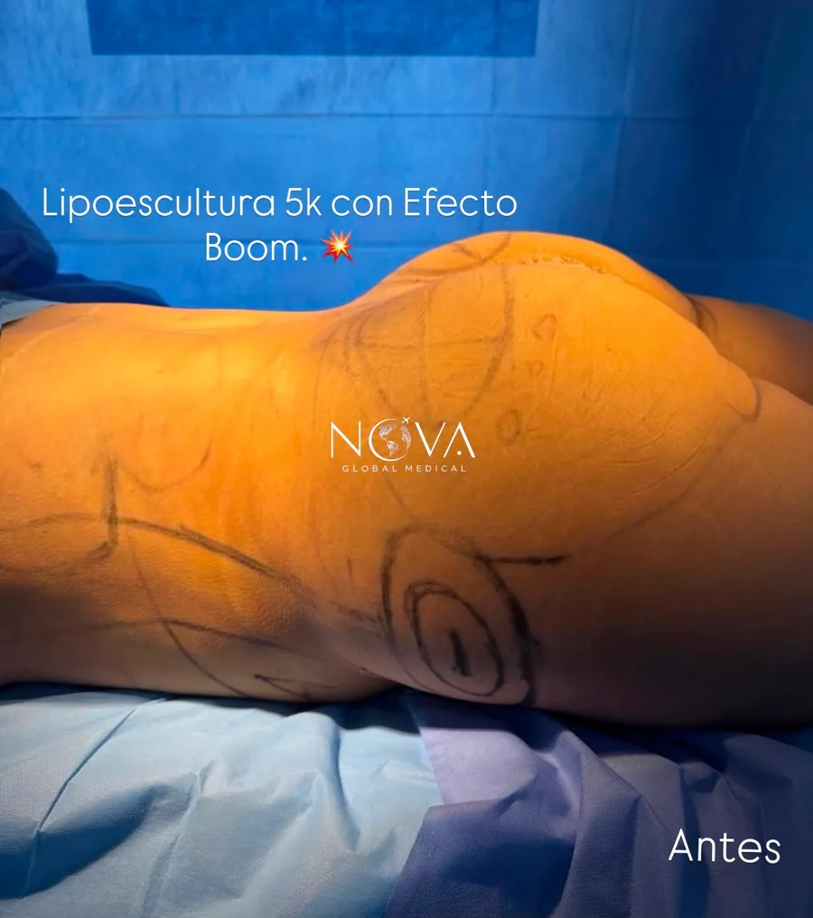 Antes de lipoescultura 5K con Efecto Boom