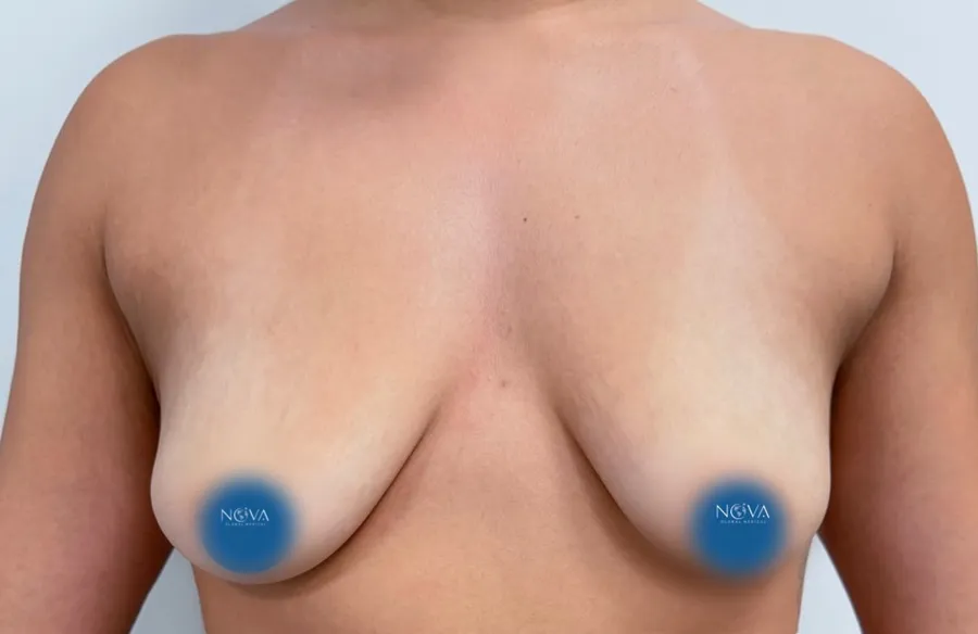 Antes de mamoplastia de aumento